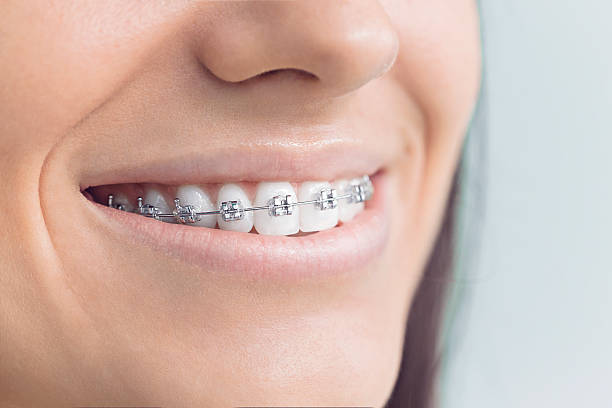 Dental Bonding in Cornwall On Hudson, NY